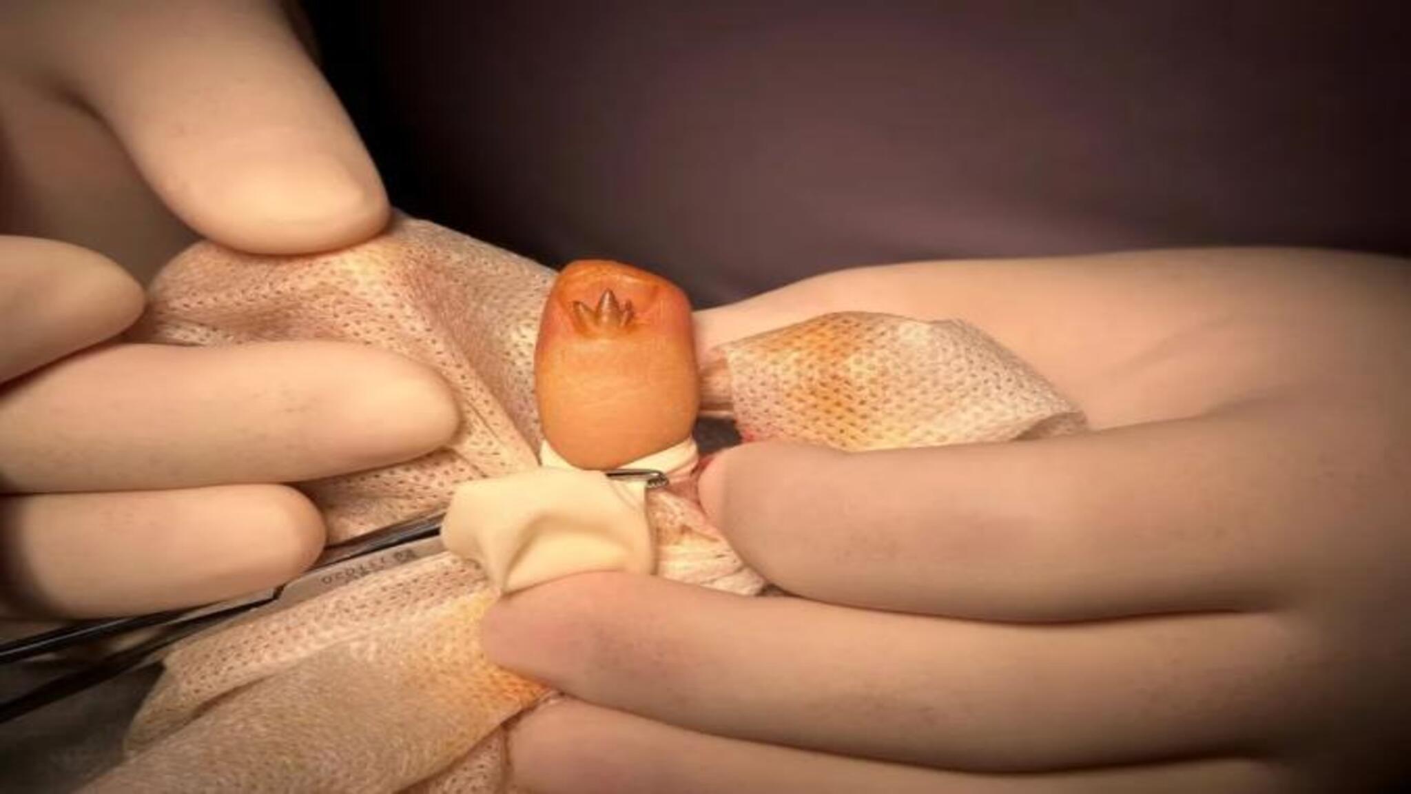 美甲引发的增生组织,医生提醒要小心